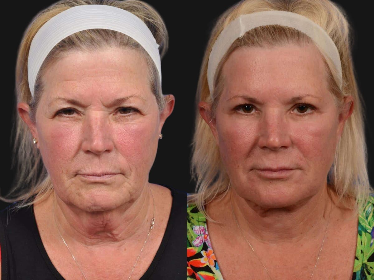 Blepharoplasty Before & After Gallery - Patient 268624 - Image 1