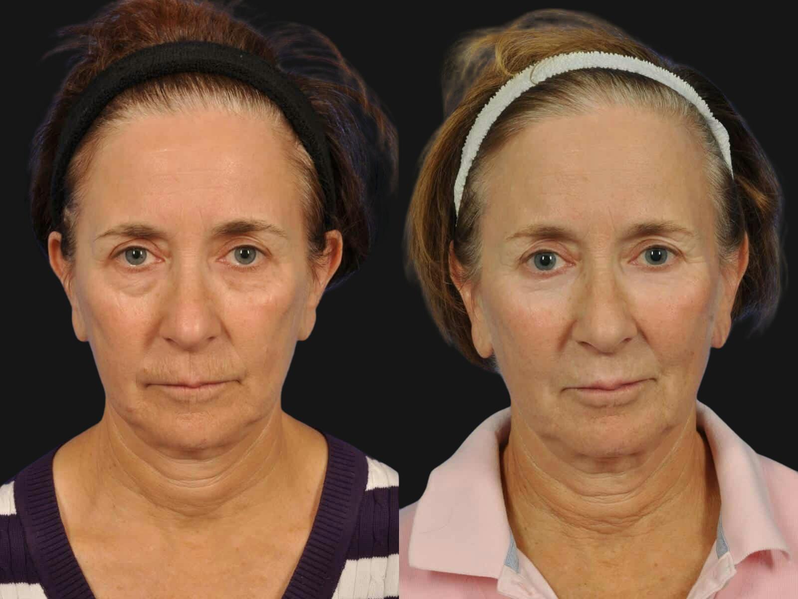 Blepharoplasty Before & After Gallery - Patient 355937 - Image 1