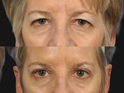 Blepharoplasty Before & After Gallery - Patient 198923 - Image 2