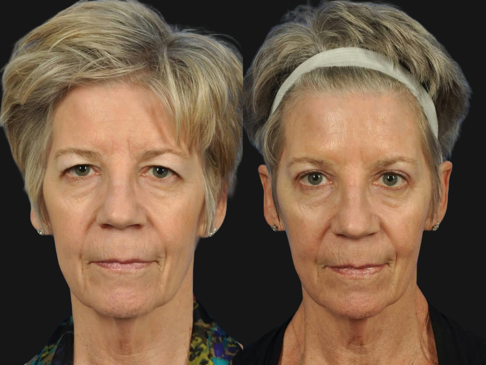 Blepharoplasty Before & After Gallery - Patient 198923 - Image 1