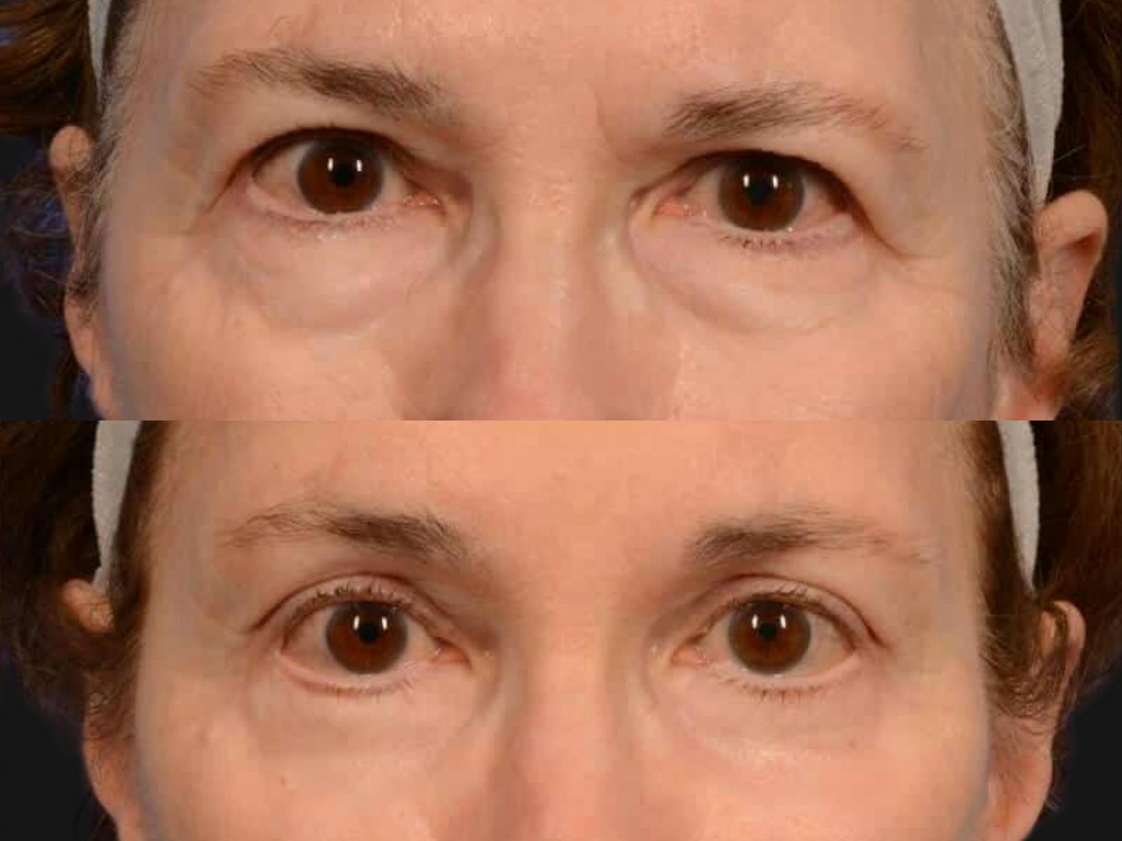 Blepharoplasty Before & After Gallery - Patient 896582 - Image 2