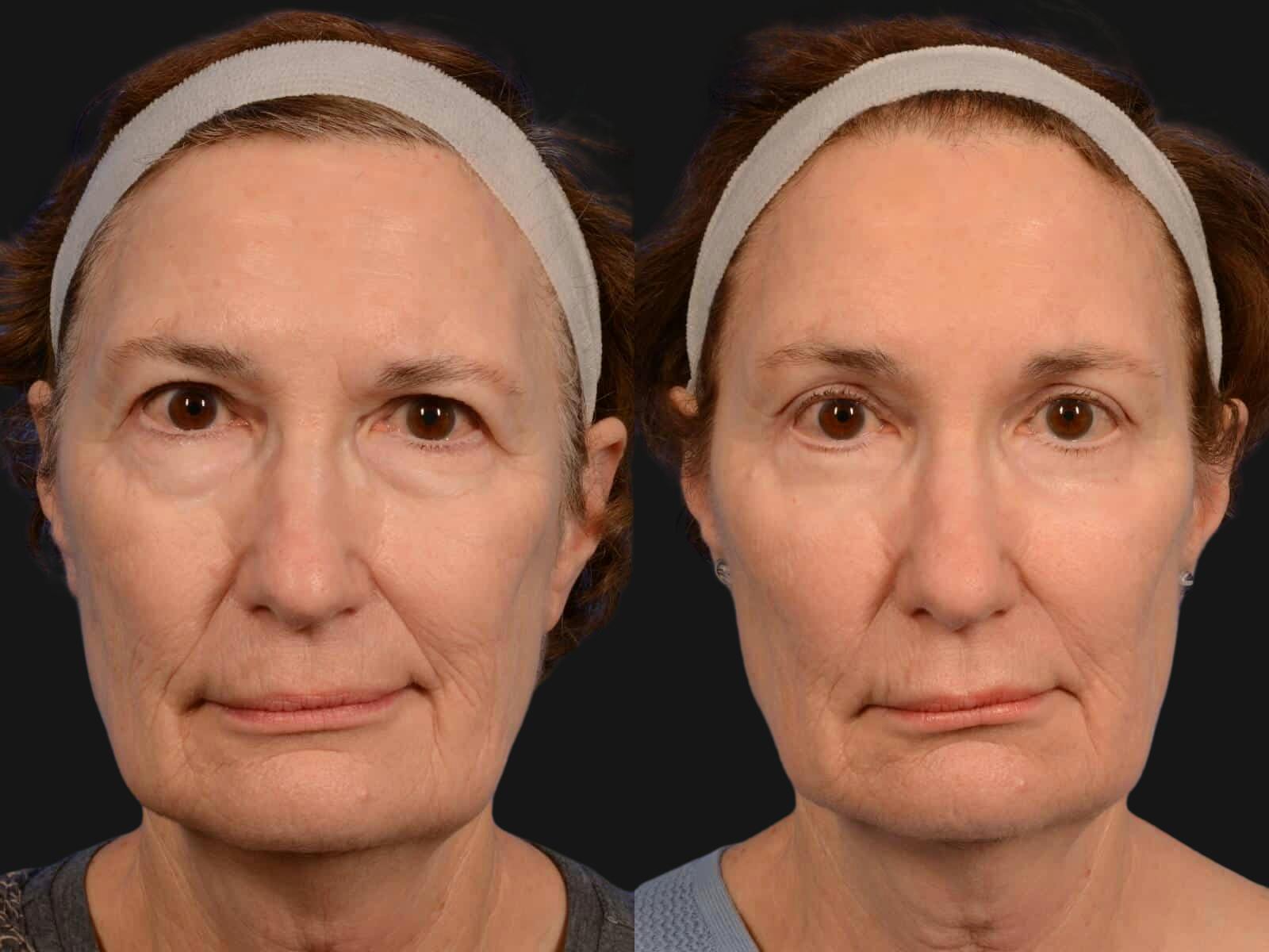 Blepharoplasty Before & After Gallery - Patient 896582 - Image 1