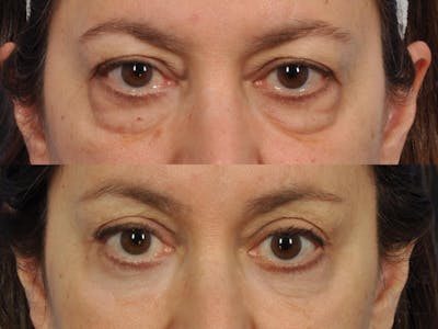 Blepharoplasty Before & After Gallery - Patient 306117 - Image 2