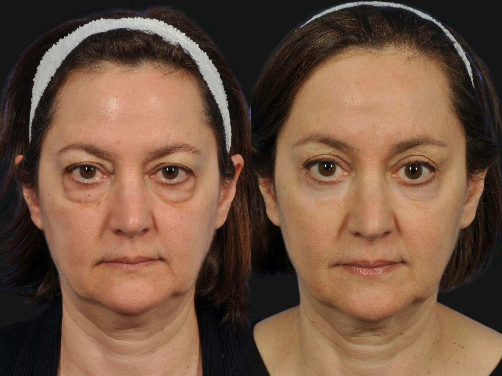Blepharoplasty Before & After Gallery - Patient 306117 - Image 1