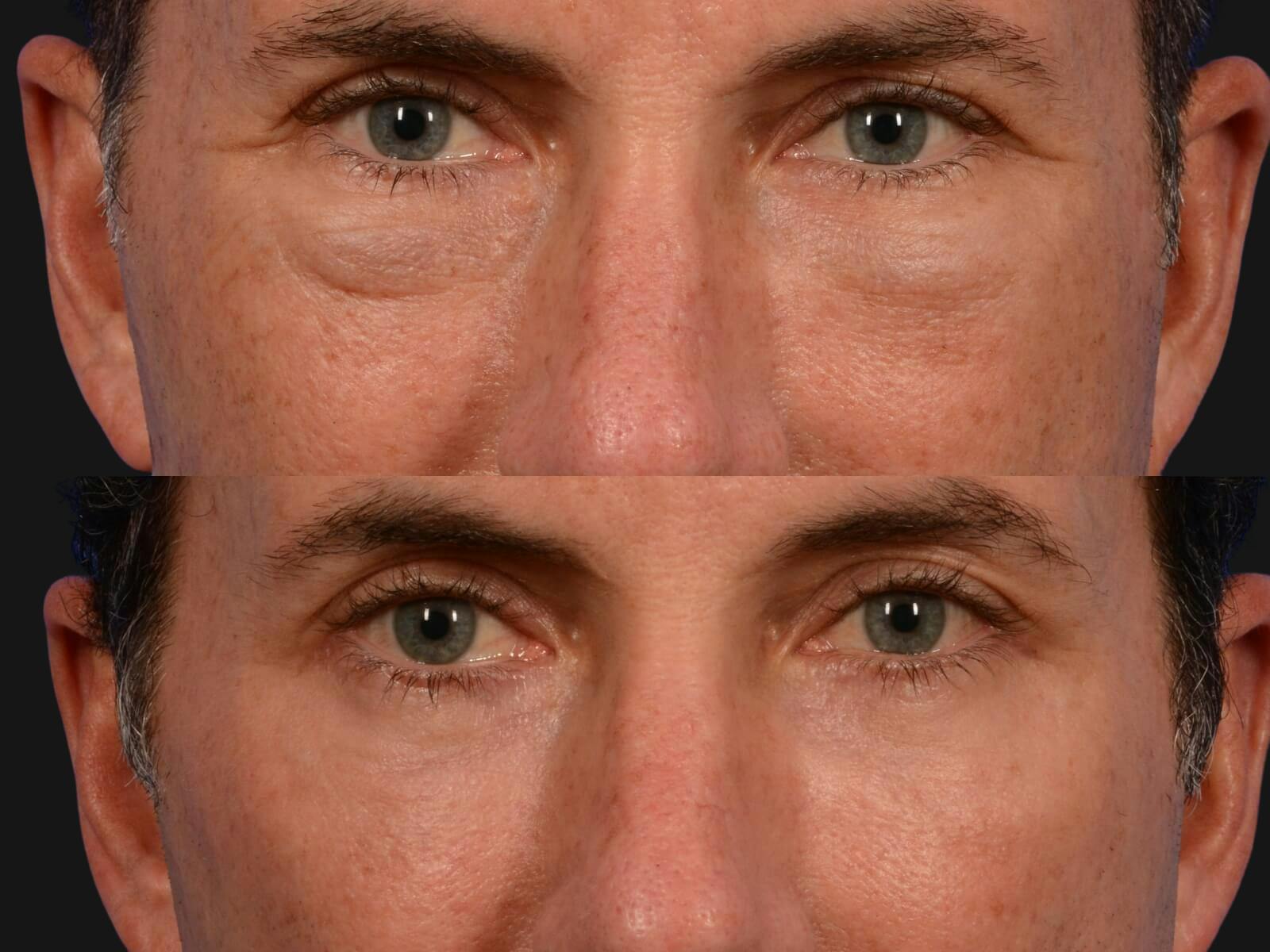 Blepharoplasty Before & After Gallery - Patient 370675 - Image 2