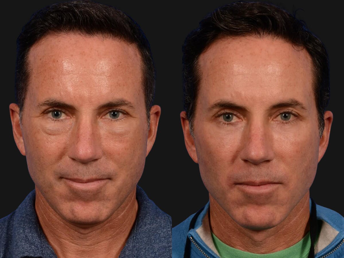Blepharoplasty Before & After Gallery - Patient 370675 - Image 1