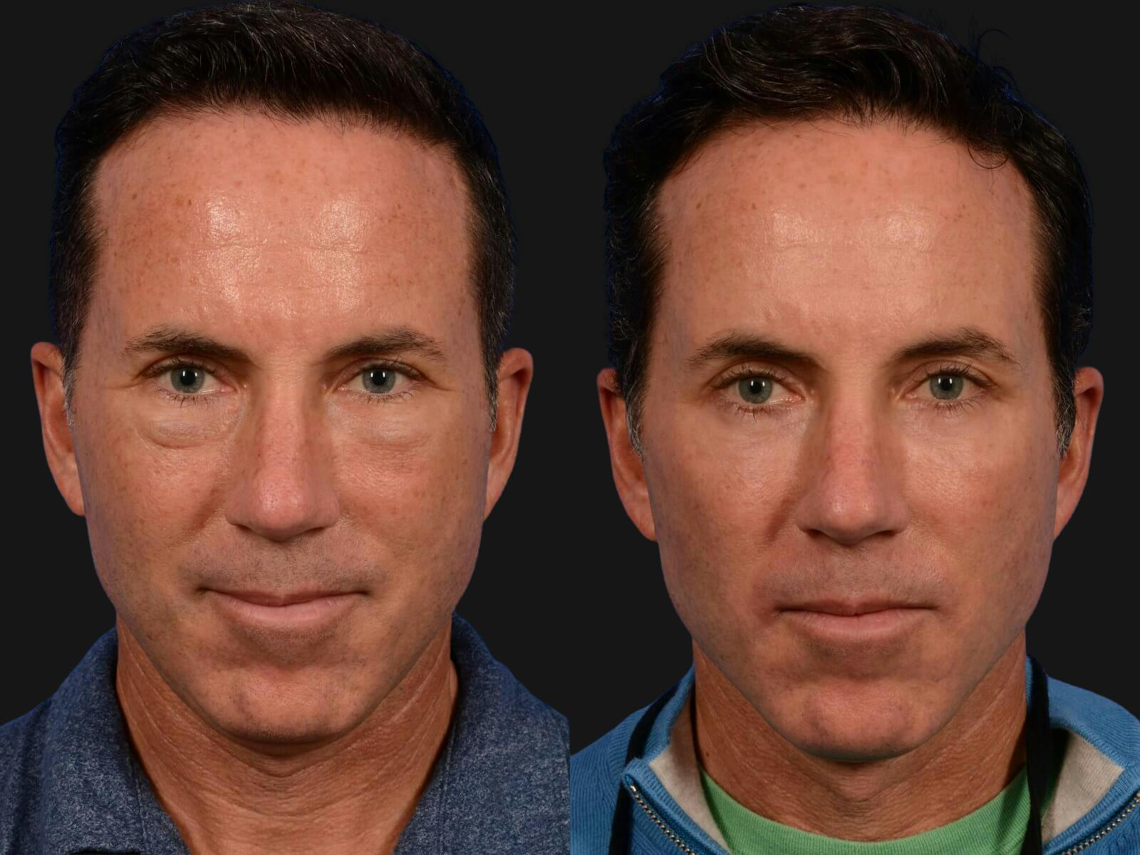 Blepharoplasty Before & After Gallery - Patient 370675 - Image 1