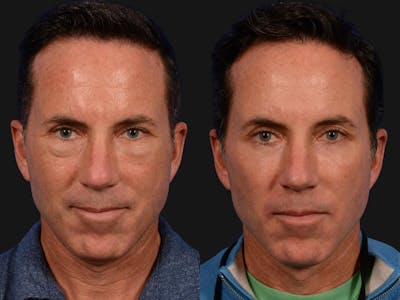 Blepharoplasty Before & After Gallery - Patient 370675 - Image 1