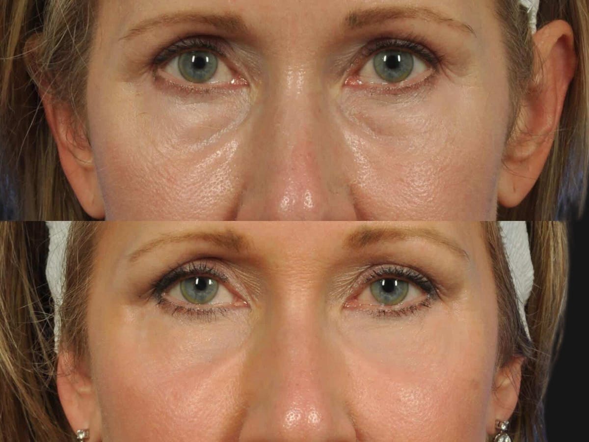Blepharoplasty Before & After Gallery - Patient 241830 - Image 1