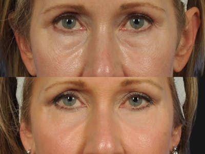 Blepharoplasty Before & After Gallery - Patient 241830 - Image 1