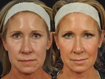 Blepharoplasty Before & After Gallery - Patient 241830 - Image 2