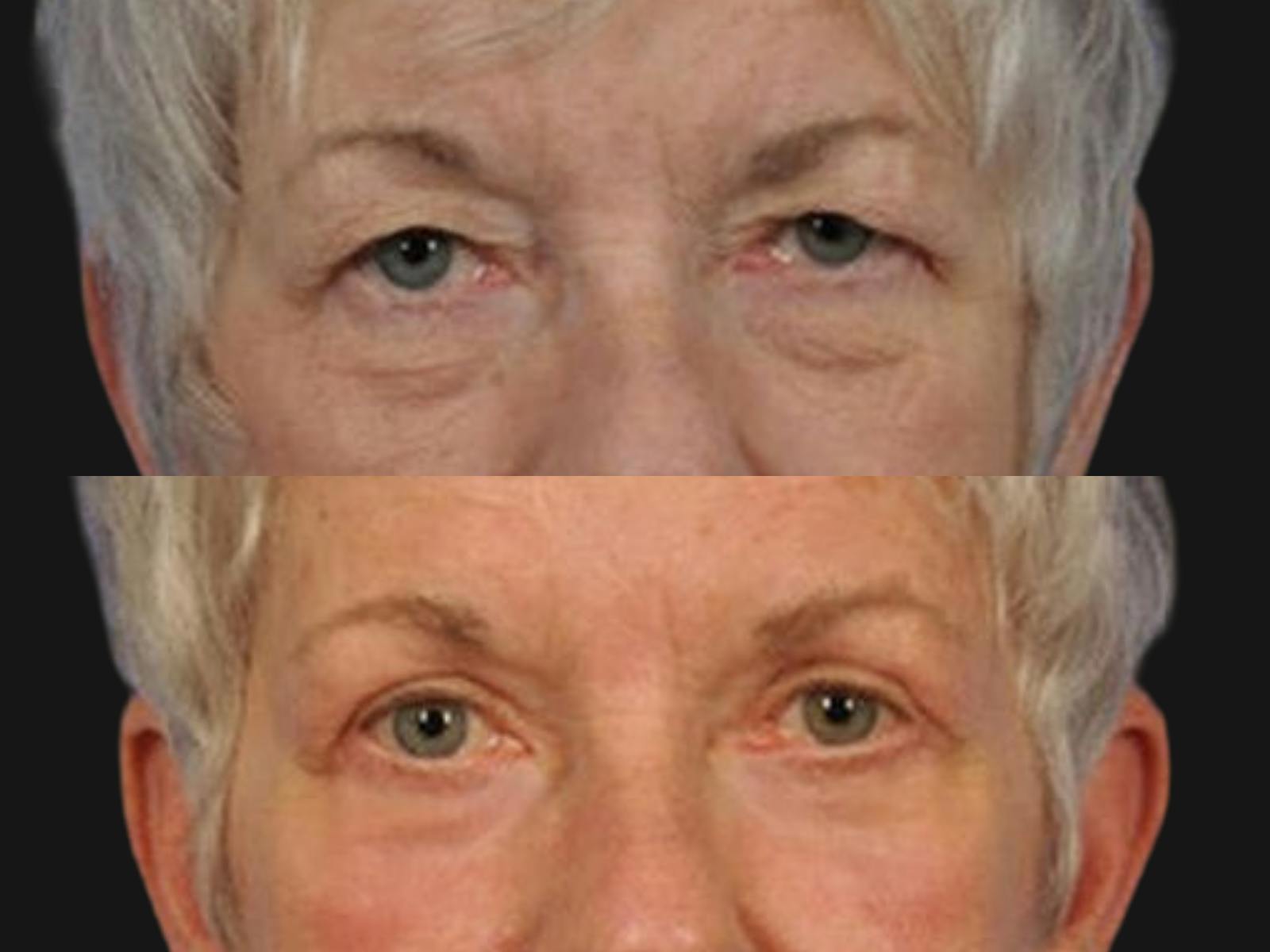 Blepharoplasty Before & After Gallery - Patient 231561 - Image 2