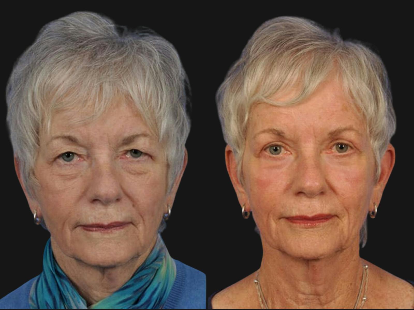 Blepharoplasty Before & After Gallery - Patient 231561 - Image 1
