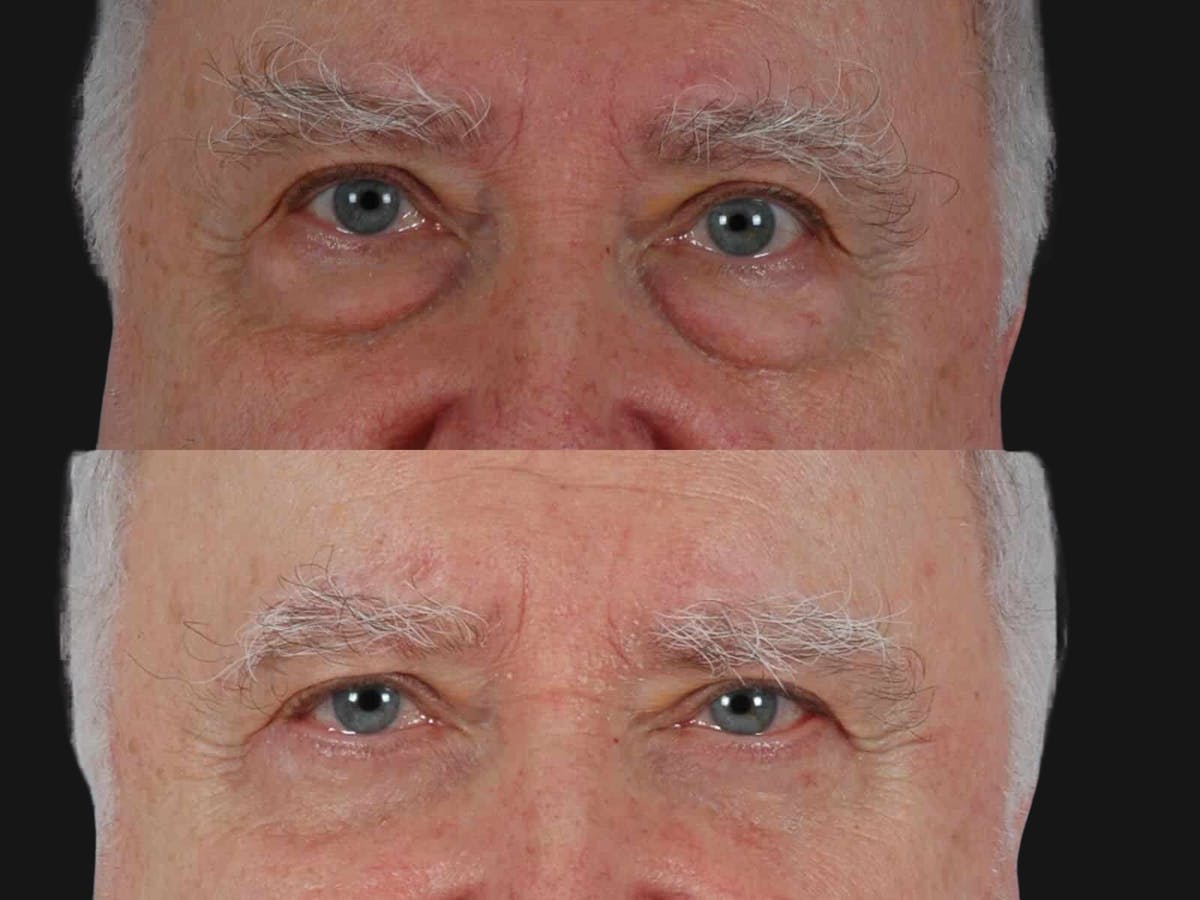 Blepharoplasty Before & After Gallery - Patient 161520 - Image 1