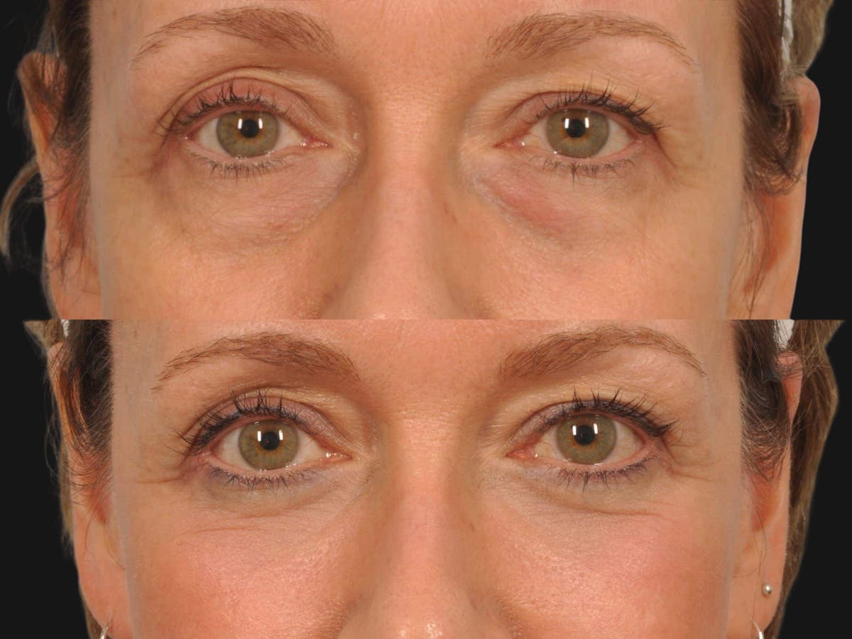 Blepharoplasty Before & After Gallery - Patient 175930 - Image 1