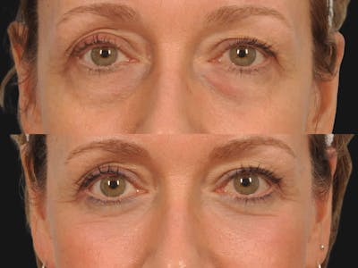 Blepharoplasty Before & After Gallery - Patient 175930 - Image 1