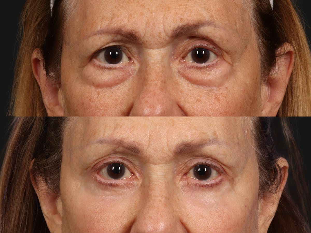 Blepharoplasty Before & After Gallery - Patient 203600 - Image 1