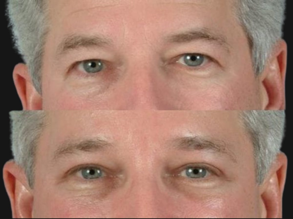 Blepharoplasty Before & After Gallery - Patient 153090 - Image 1