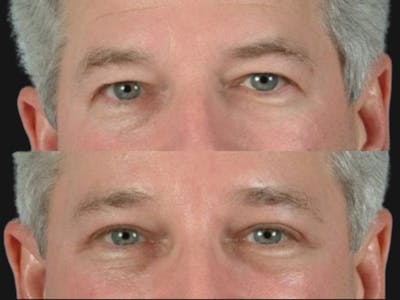 Blepharoplasty Before & After Gallery - Patient 153090 - Image 1