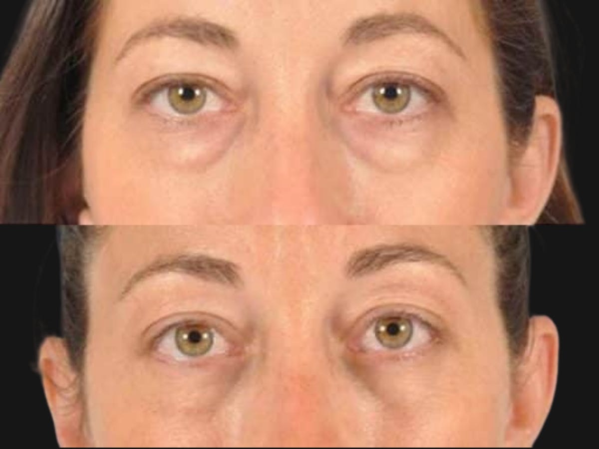 Blepharoplasty Before & After Gallery - Patient 213158 - Image 1