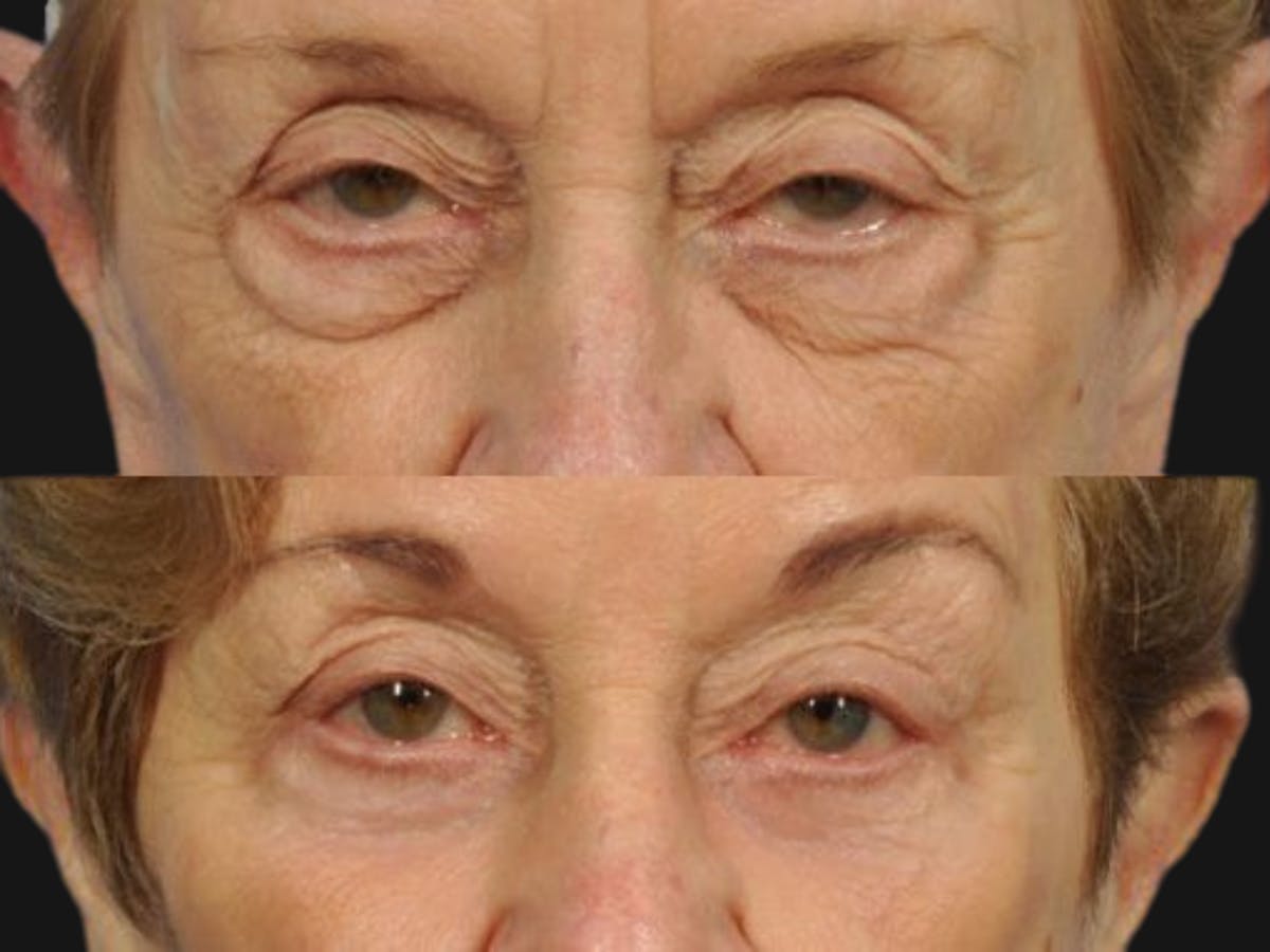 Blepharoplasty Before & After Gallery - Patient 153454 - Image 1