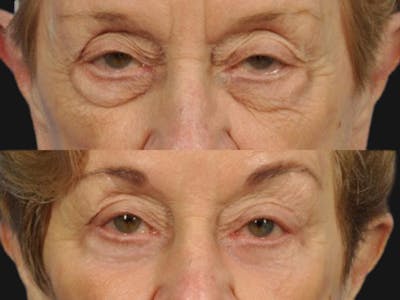 Blepharoplasty Before & After Gallery - Patient 153454 - Image 1