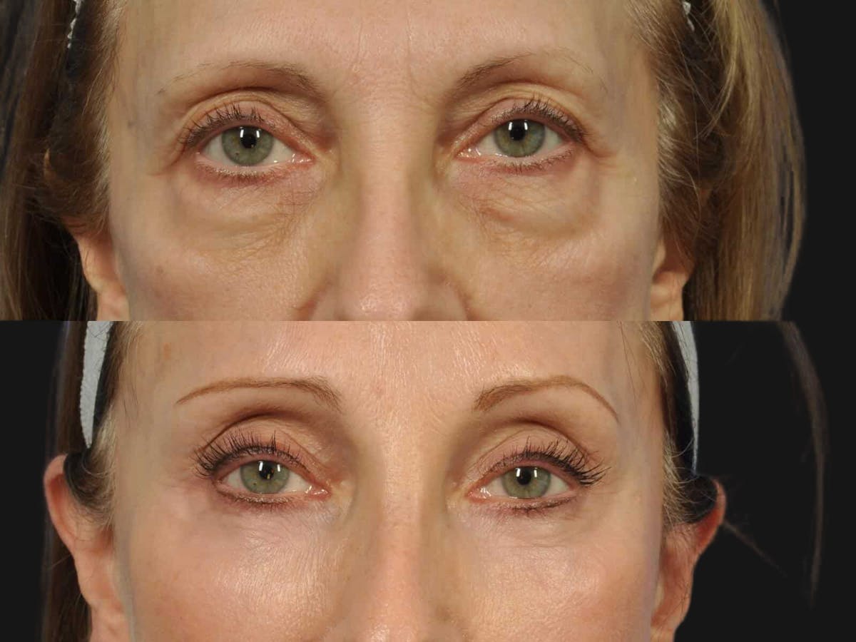 Blepharoplasty Before & After Gallery - Patient 149149 - Image 1