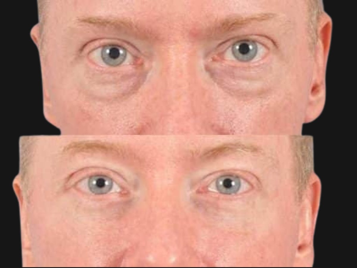 Blepharoplasty Before & After Gallery - Patient 193536 - Image 1