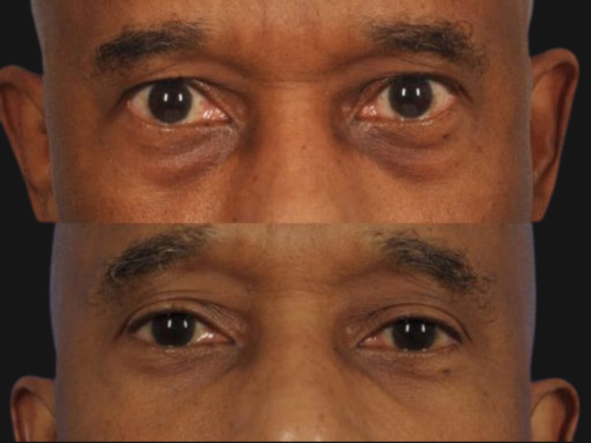 Blepharoplasty Before & After Gallery - Patient 260618 - Image 1