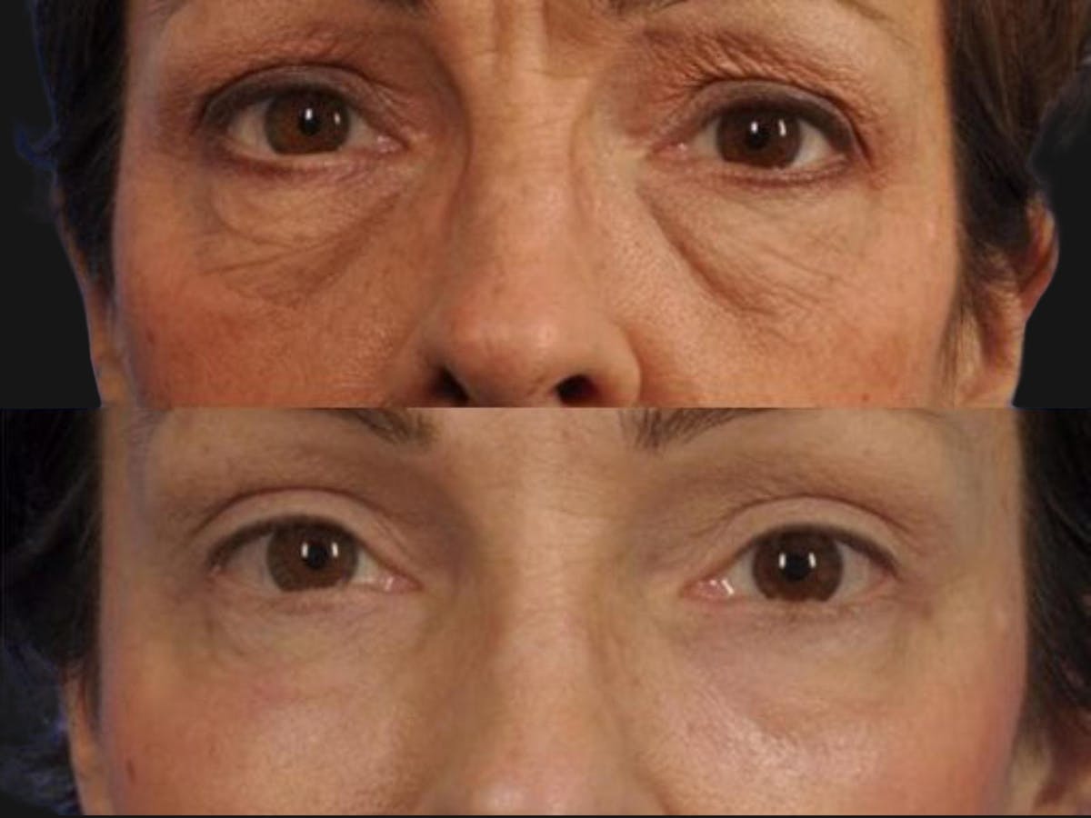 Blepharoplasty Before & After Gallery - Patient 131661 - Image 1
