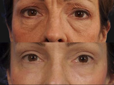 Blepharoplasty Before & After Gallery - Patient 131661 - Image 1