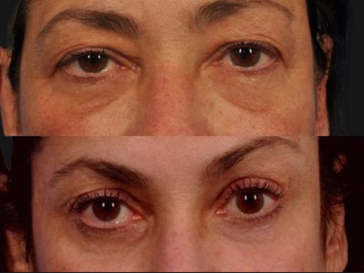 Blepharoplasty Before & After Gallery - Patient 339773 - Image 1