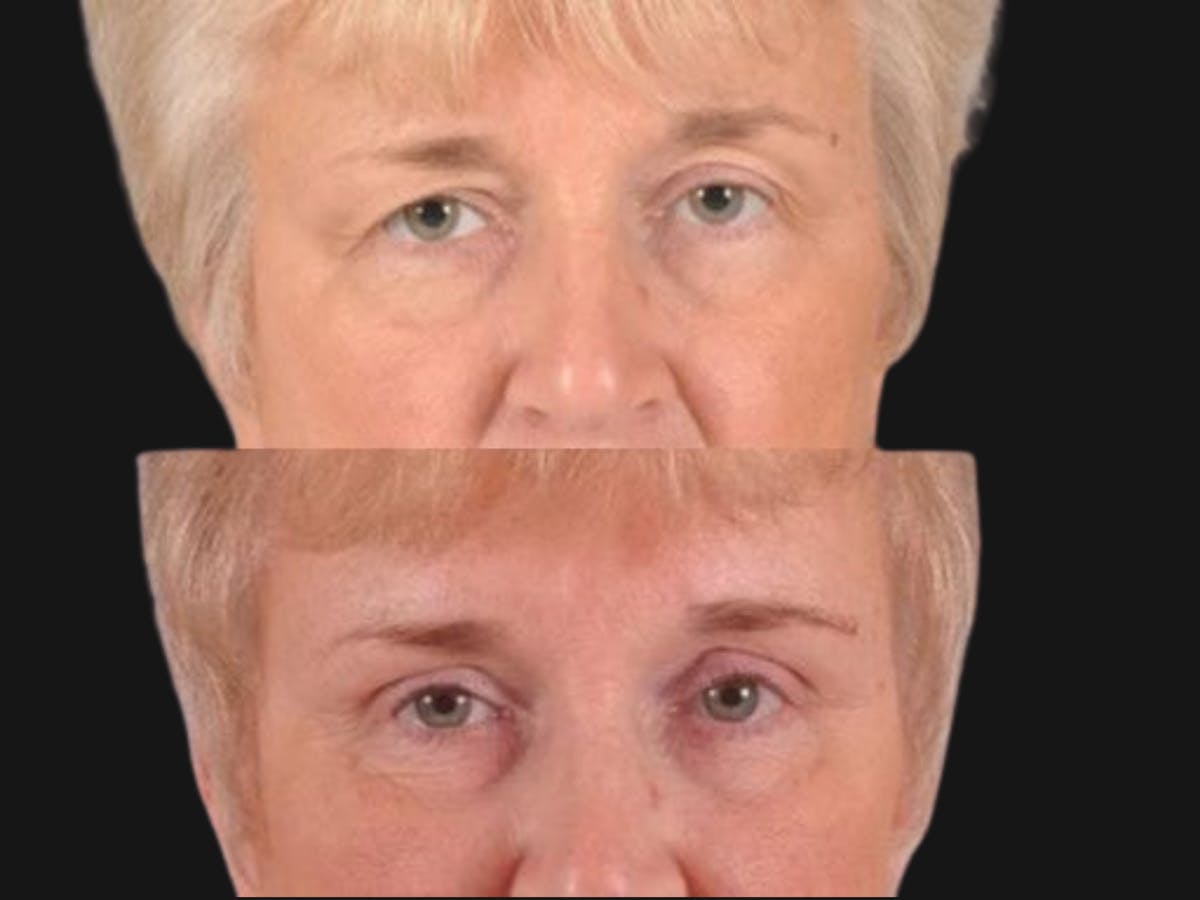 Blepharoplasty Before & After Gallery - Patient 221122 - Image 1
