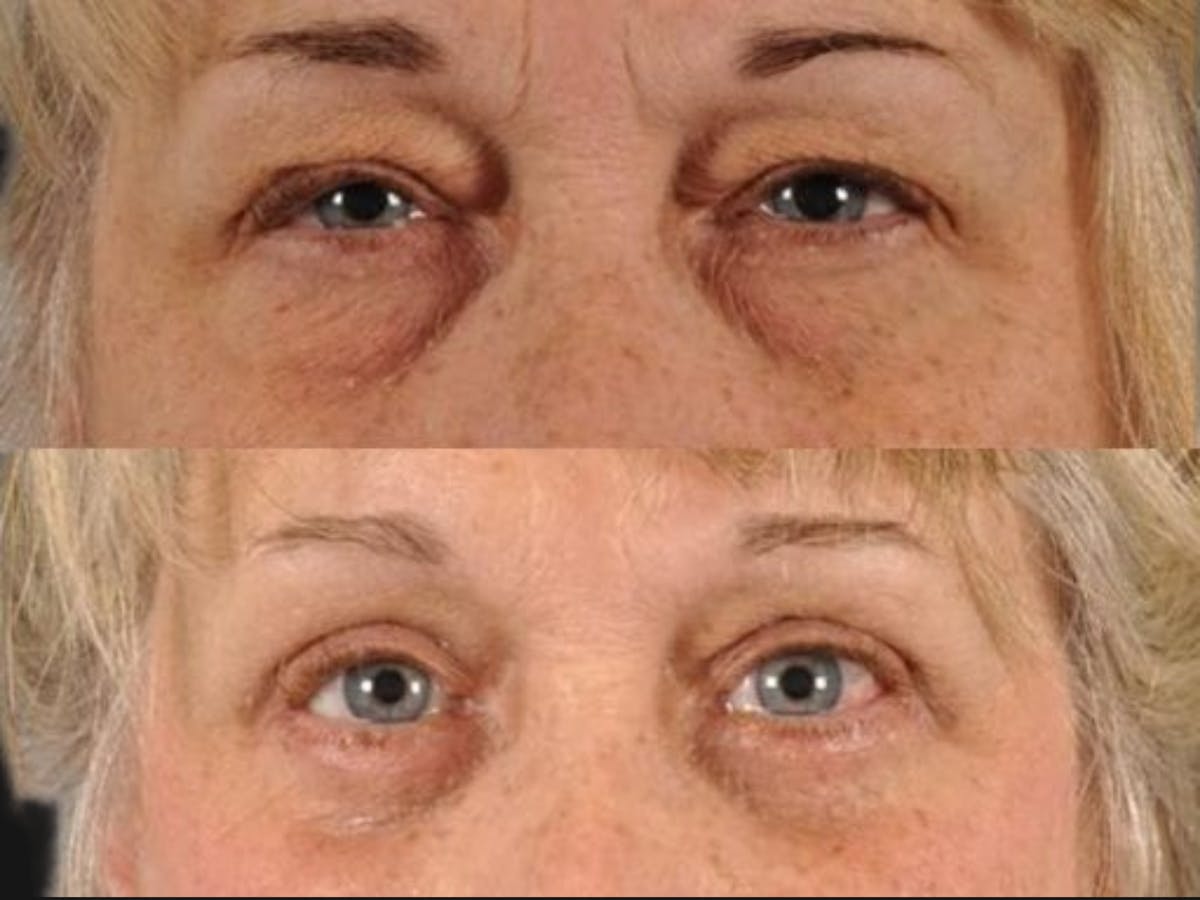 Blepharoplasty Before & After Gallery - Patient 111973 - Image 1