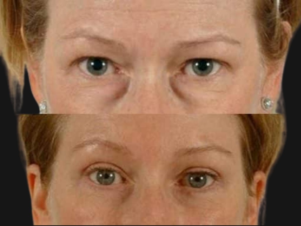 Blepharoplasty Before & After Gallery - Patient 318943 - Image 1