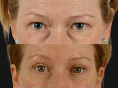 Blepharoplasty Before & After Gallery - Patient 318943 - Image 1