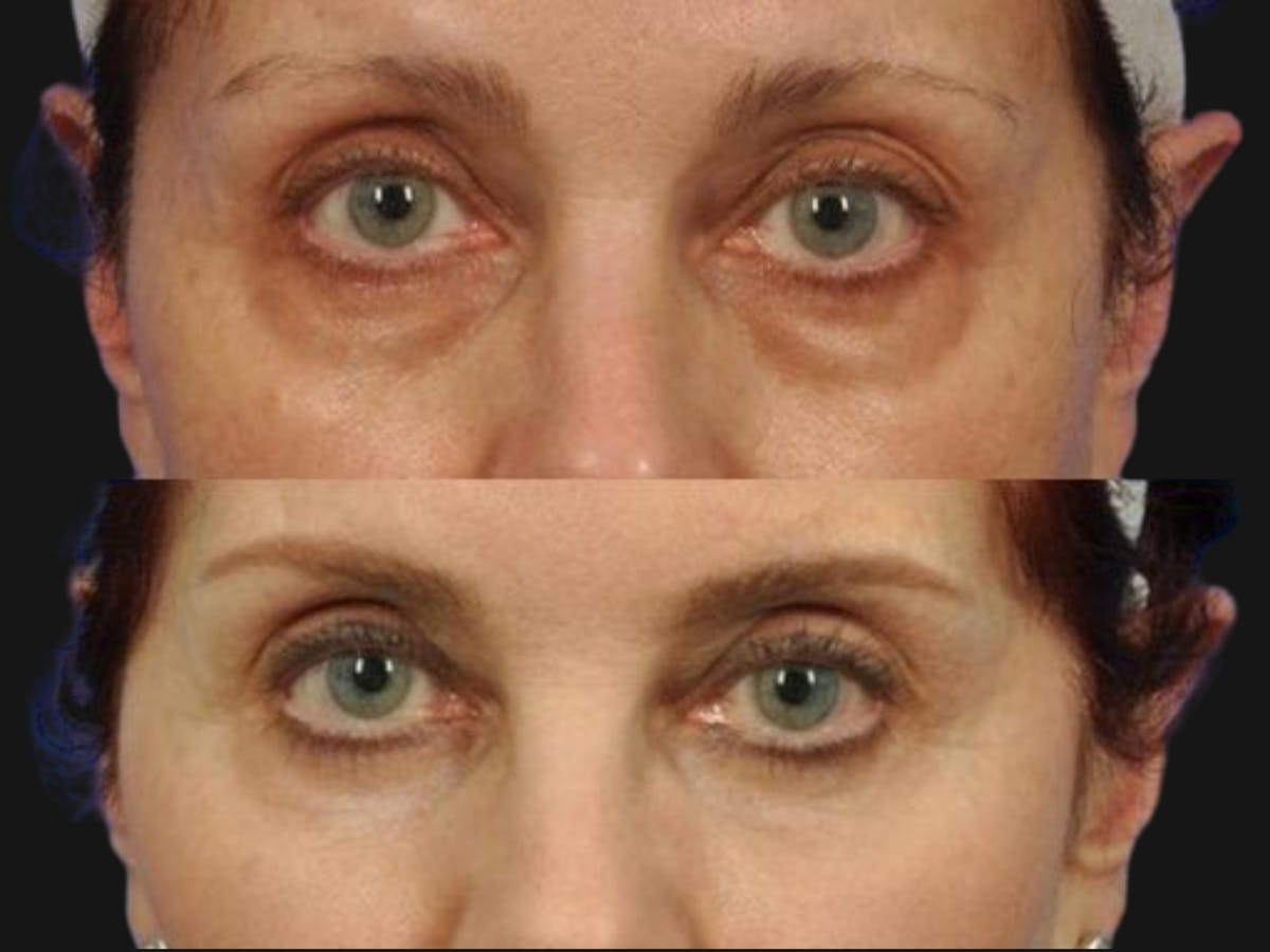 Blepharoplasty Before & After Gallery - Patient 335218 - Image 1