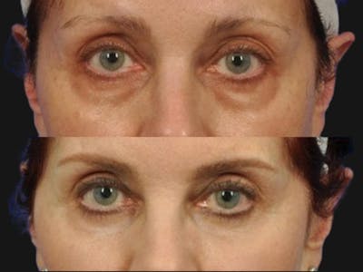 Blepharoplasty Before & After Gallery - Patient 335218 - Image 1