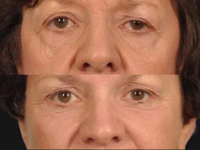 Blepharoplasty Before & After Gallery - Patient 281764 - Image 1