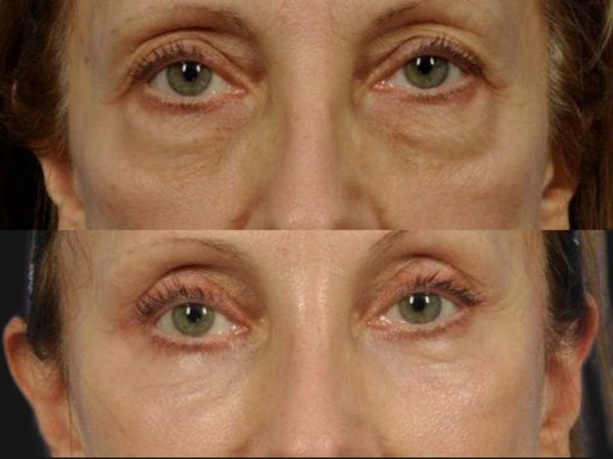 Blepharoplasty Before & After Gallery - Patient 229758 - Image 1