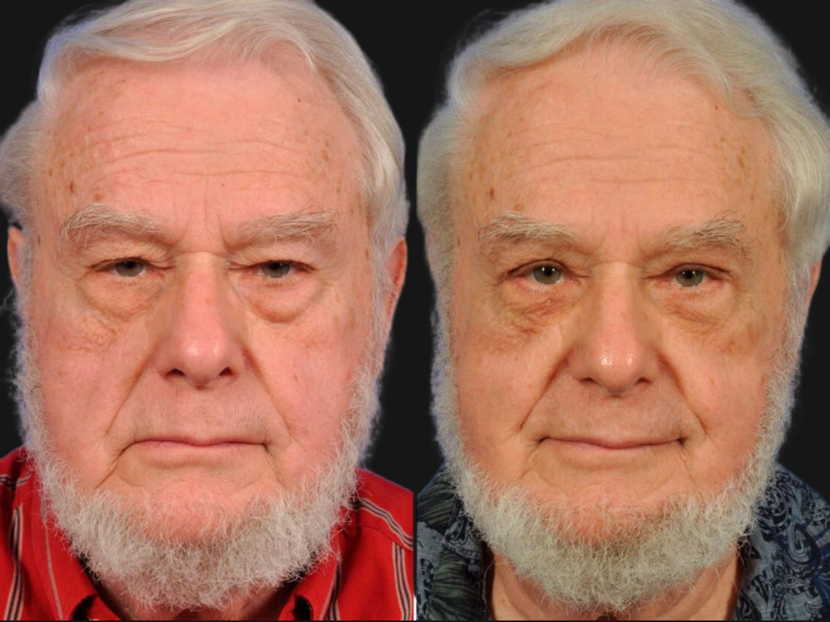 Droopy Eyelids – Ptosis Before & After Gallery - Patient 273320 - Image 1