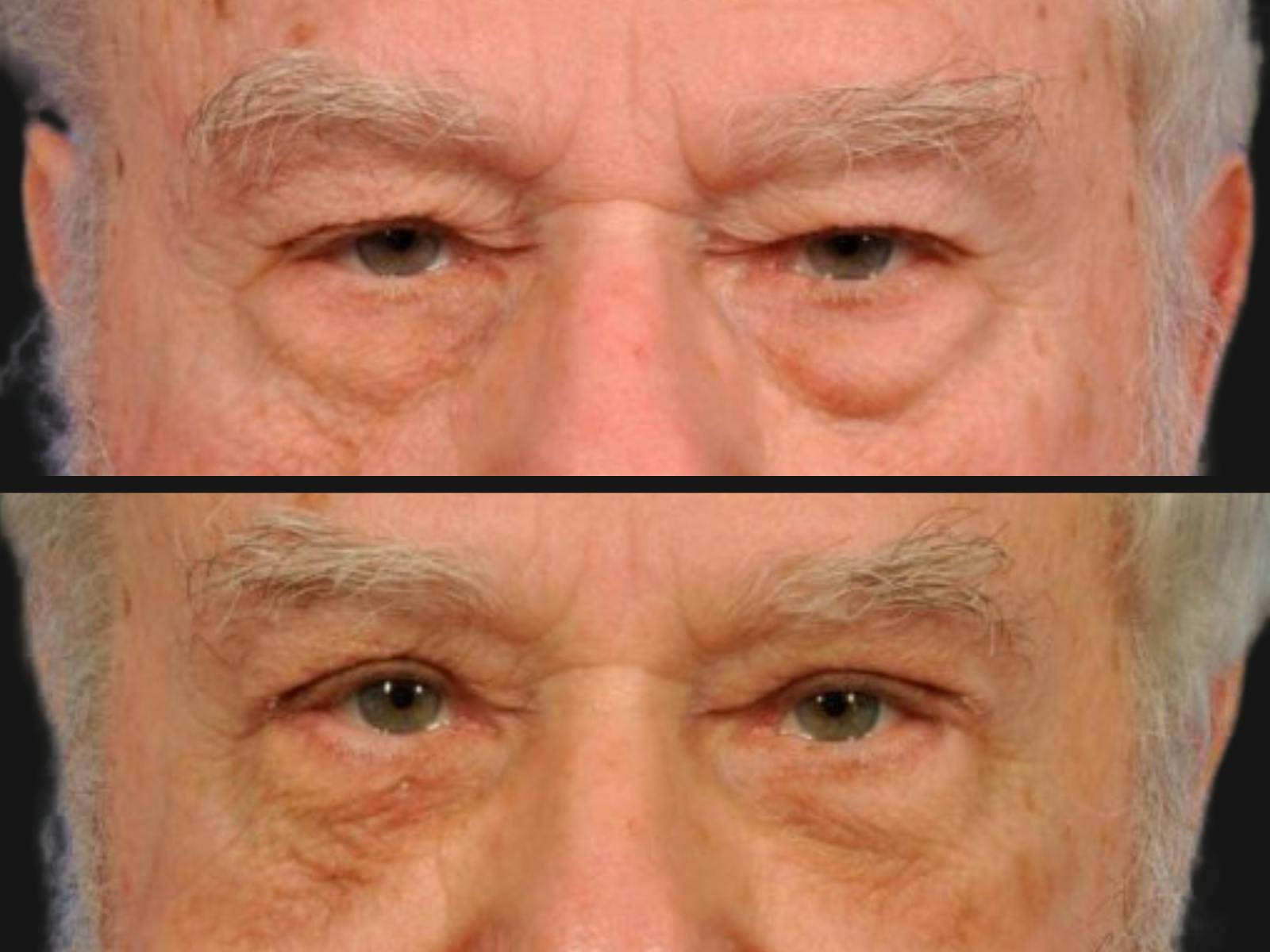 Droopy Eyelids – Ptosis Before & After Gallery - Patient 273320 - Image 2