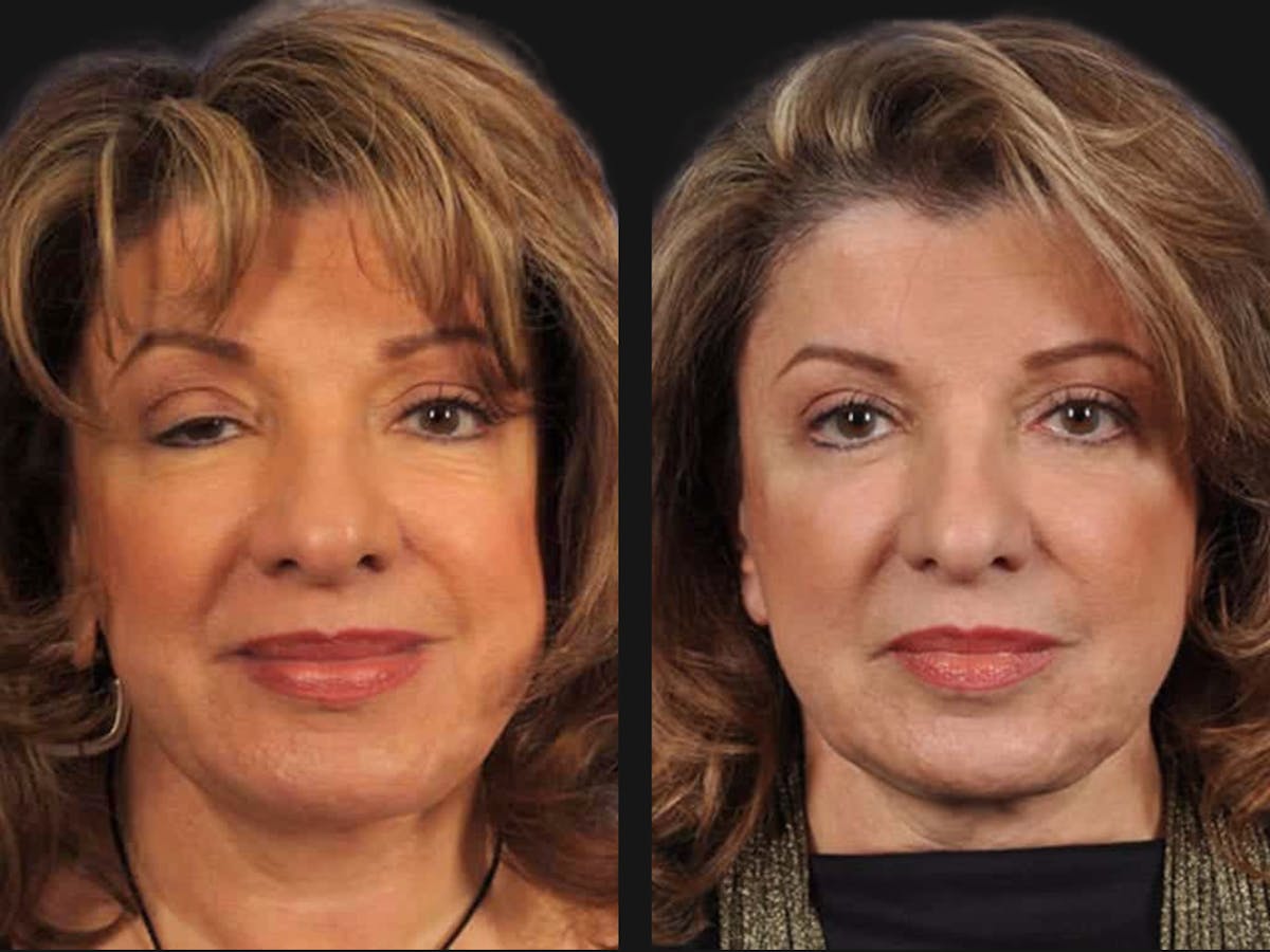 Blepharoplasty Before & After Gallery - Patient 871073 - Image 1