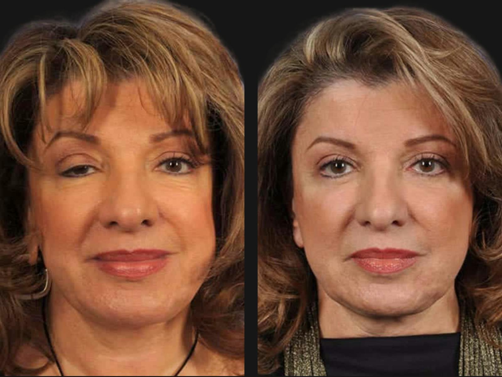 Droopy Eyelids – Ptosis Before & After Gallery - Patient 374846 - Image 1