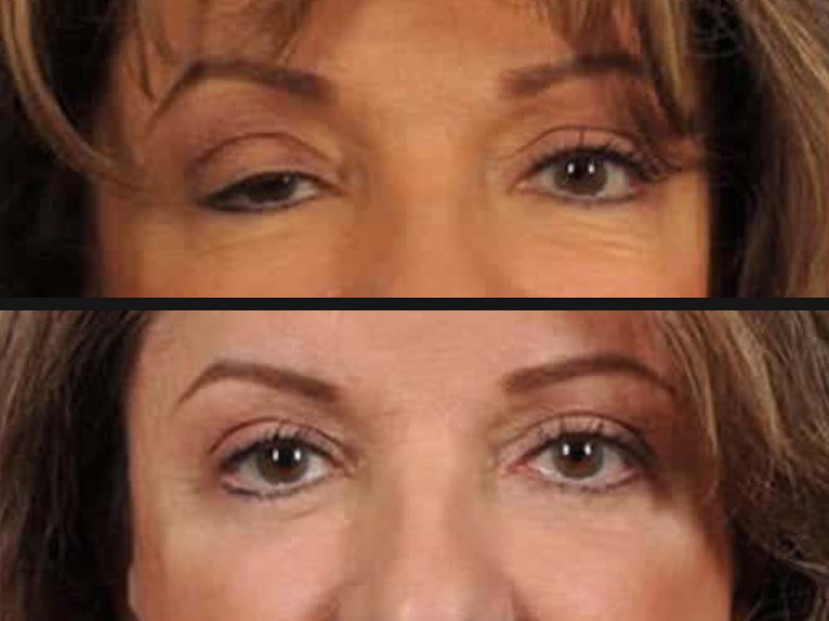 Blepharoplasty Before & After Gallery - Patient 871073 - Image 2
