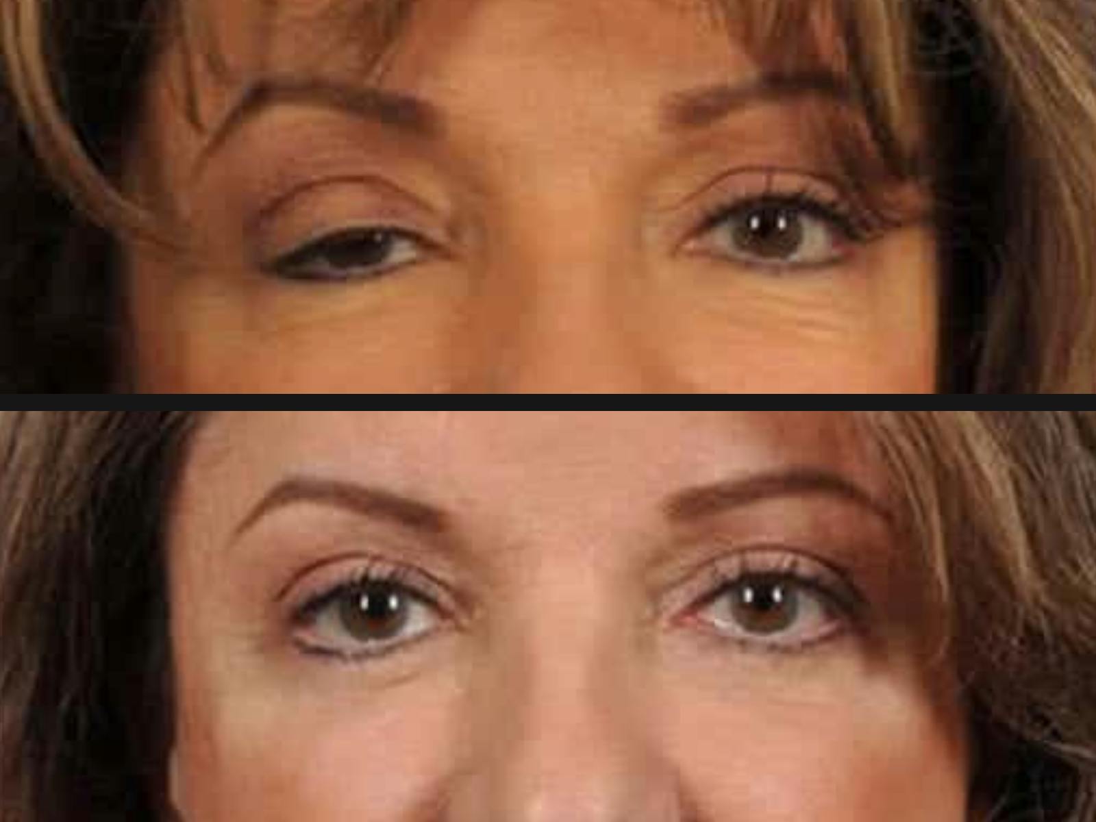 Droopy Eyelids – Ptosis Before & After Gallery - Patient 374846 - Image 2
