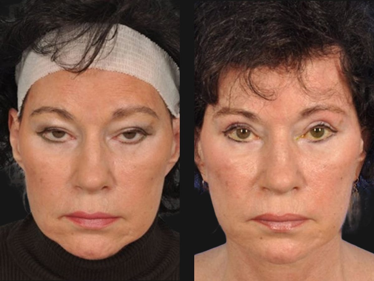 Blepharoplasty Before & After Gallery - Patient 514548 - Image 1