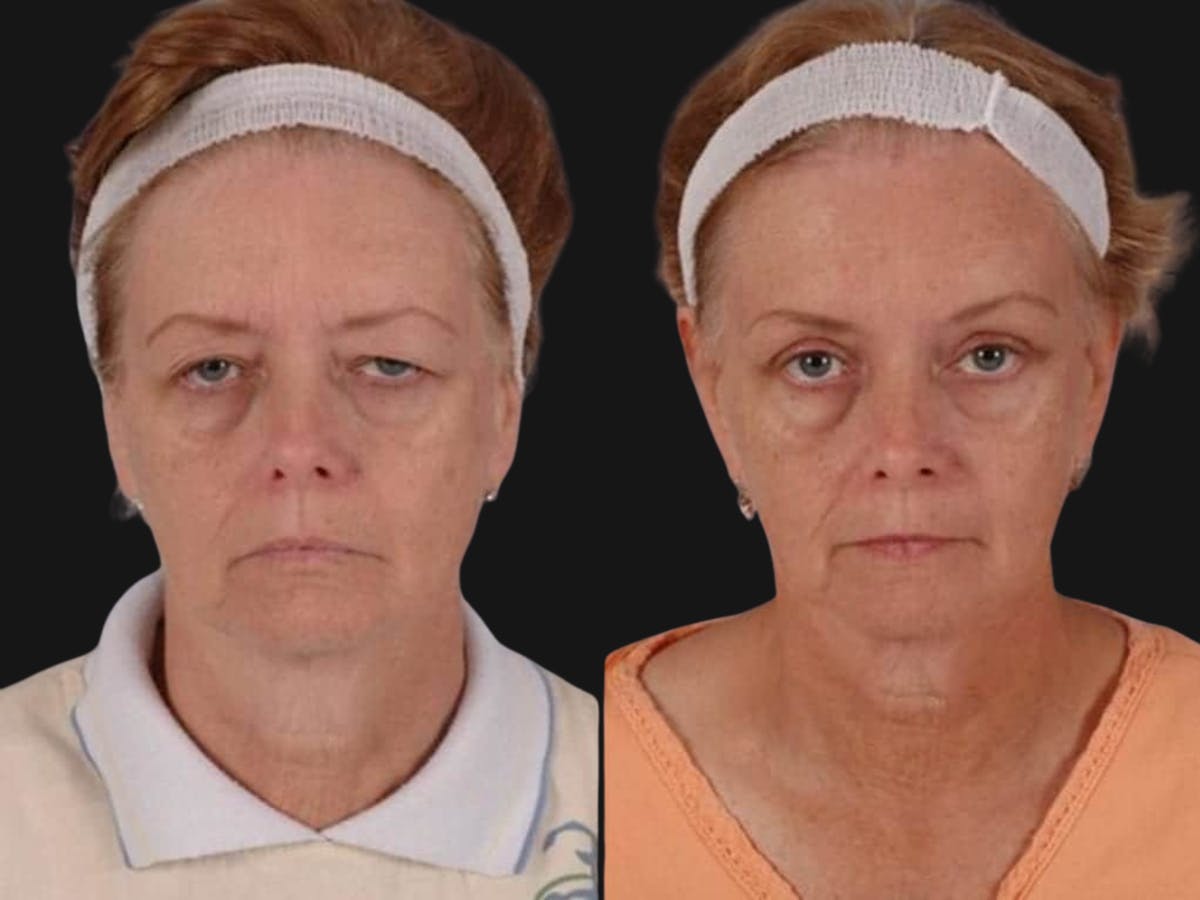 Blepharoplasty Before & After Gallery - Patient 428282 - Image 1