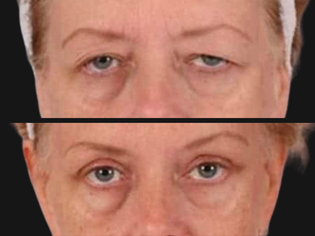 Blepharoplasty Before & After Gallery - Patient 428282 - Image 2