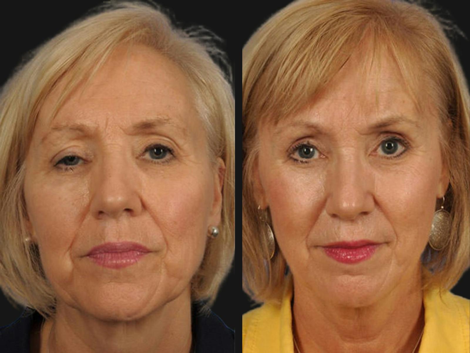 Droopy Eyelids – Ptosis Before & After Gallery - Patient 245463 - Image 1